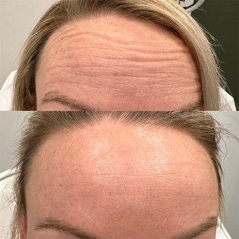 Botox for Forehead Lines